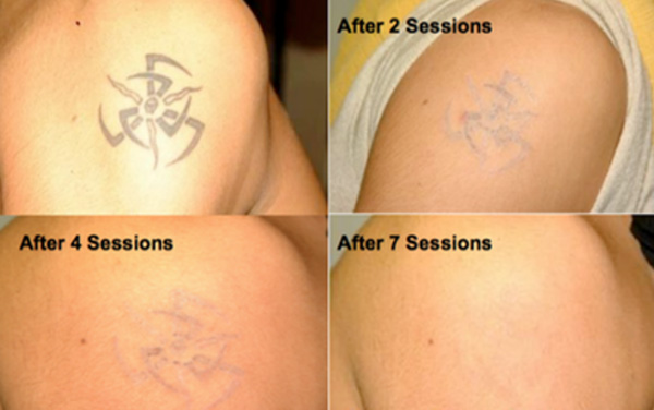 How-to-clear-and-remove-tattoos-with-the-new-laser-Q-switch-images-4