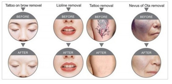 How-to-clear-and-remove-tattoos-with-the-new-laser-Q-switch-images-6